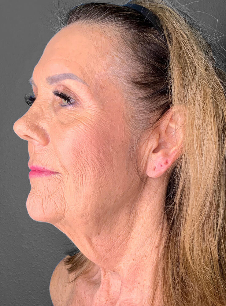 Profile view of a mature woman highlighting skin rejuvenation results.