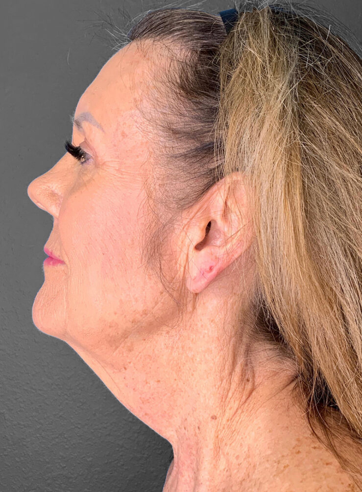 Profile view of a woman highlighting natural facial contours post-surgery.