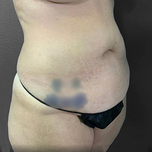 Before and after body contouring results at Lentz Plastic Surgery.