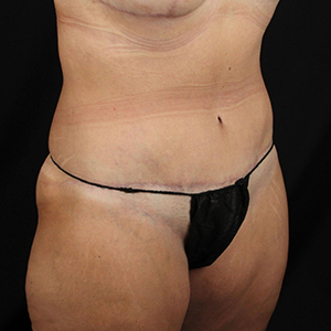Body contouring results highlighting smooth skin and natural curves.