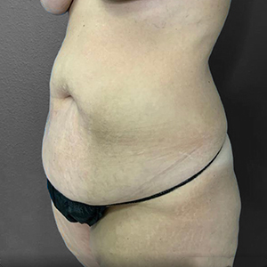 Before and after body contouring results at Lentz Plastic Surgery.