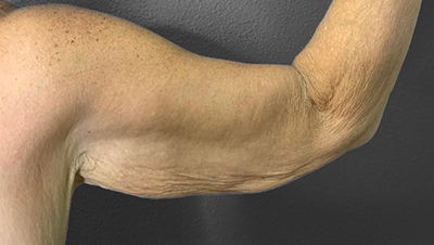 Toned arm highlighting skin texture post-plastic surgery at Lentz Plastic Surgery.