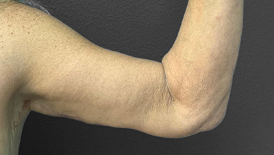 Before and after arm contouring results at Lentz Plastic Surgery.