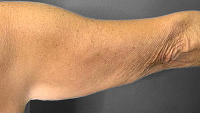 Smooth, rejuvenated arm skin showcasing Lentz Plastic Surgery's expertise.