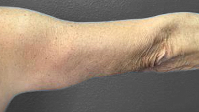 Before and after arm rejuvenation at Lentz Plastic Surgery.