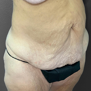 Realistic body model showcasing skin texture for Lentz Plastic Surgery consultations.