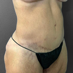 Post-surgery body contouring results highlighting smooth skin and improved shape.