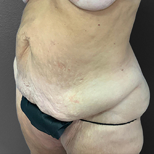 Realistic body model highlighting surgical results at Lentz Plastic Surgery.