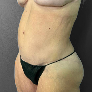 Before and after body contouring results at Lentz Plastic Surgery.