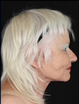 Profile view of a woman with platinum hair, showcasing facial aesthetics.