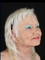 Facelift results highlighting smooth skin and rejuvenated appearance. Lentz Plastic Surgery.