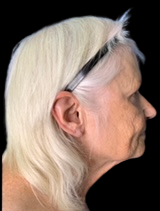 Before facelift profile view highlighting facial aging signs. Lentz Plastic Surgery.