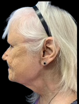 Left profile view of patient before facelift at Lentz Plastic Surgery.