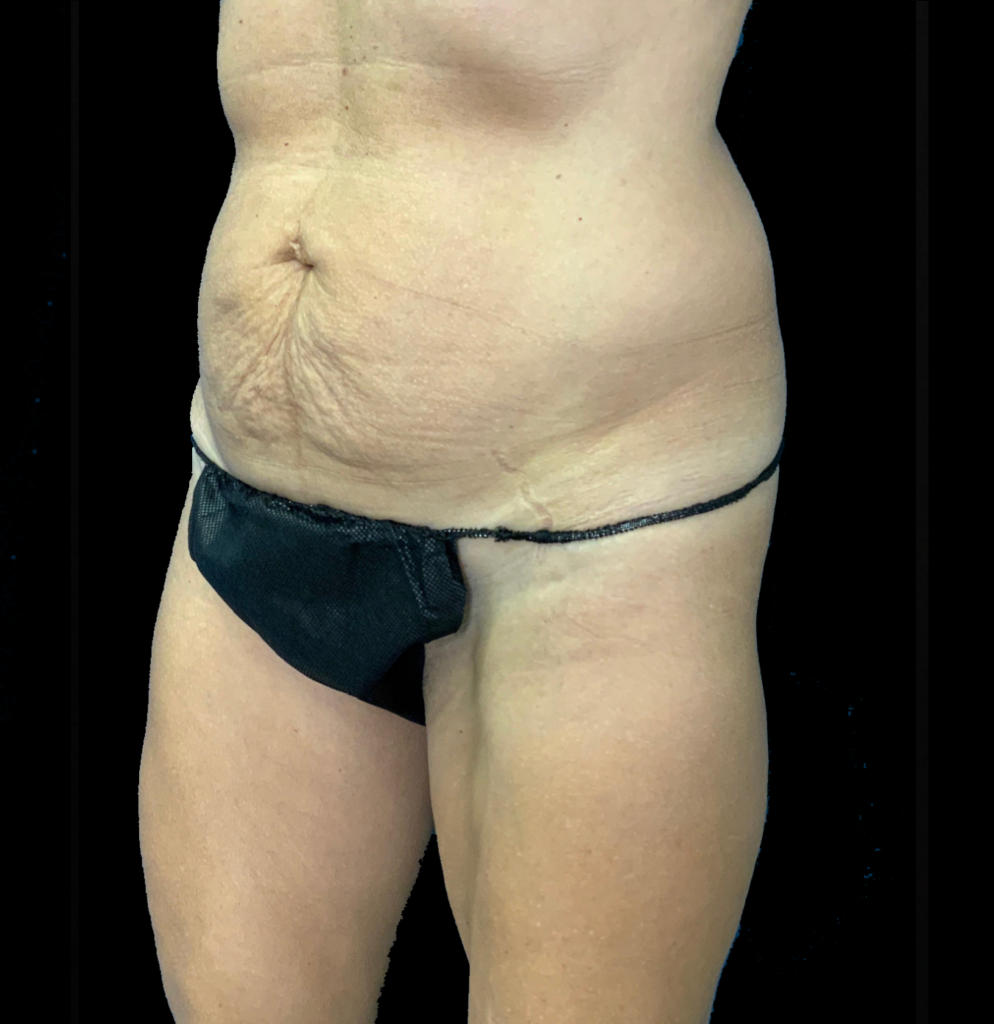 Before and after transformation highlighting body contouring results.