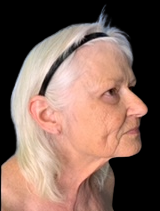 Profile view of patient before facelift at Lentz Plastic Surgery.