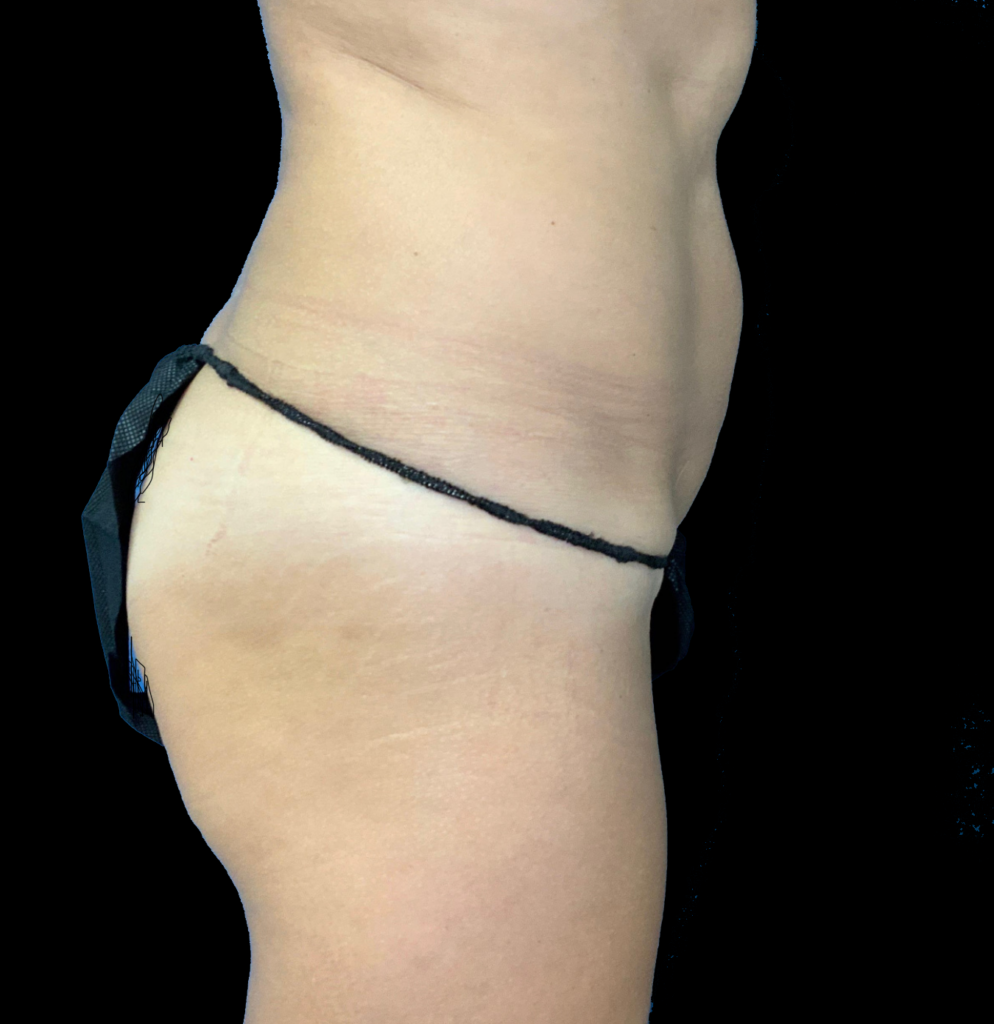 Before body contouring procedure, highlighting abdomen and waist area.