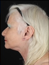 Left profile view of patient post-facelift, showcasing rejuvenated facial contours.
