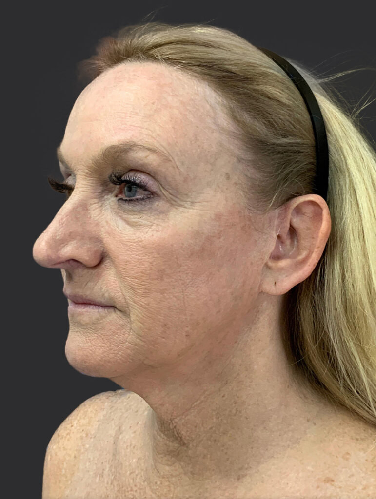 Profile view of a woman showcasing natural results from Lentz Plastic Surgery.