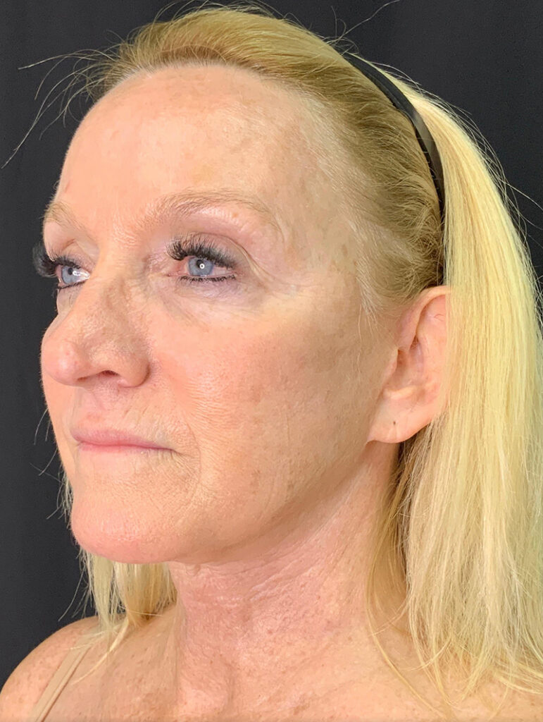 Patient consultation highlighting natural beauty and professional care at Lentz Plastic Surgery.