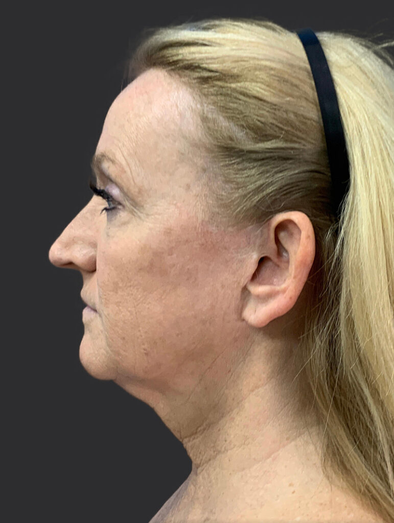 Profile view of a woman showcasing natural results of plastic surgery.