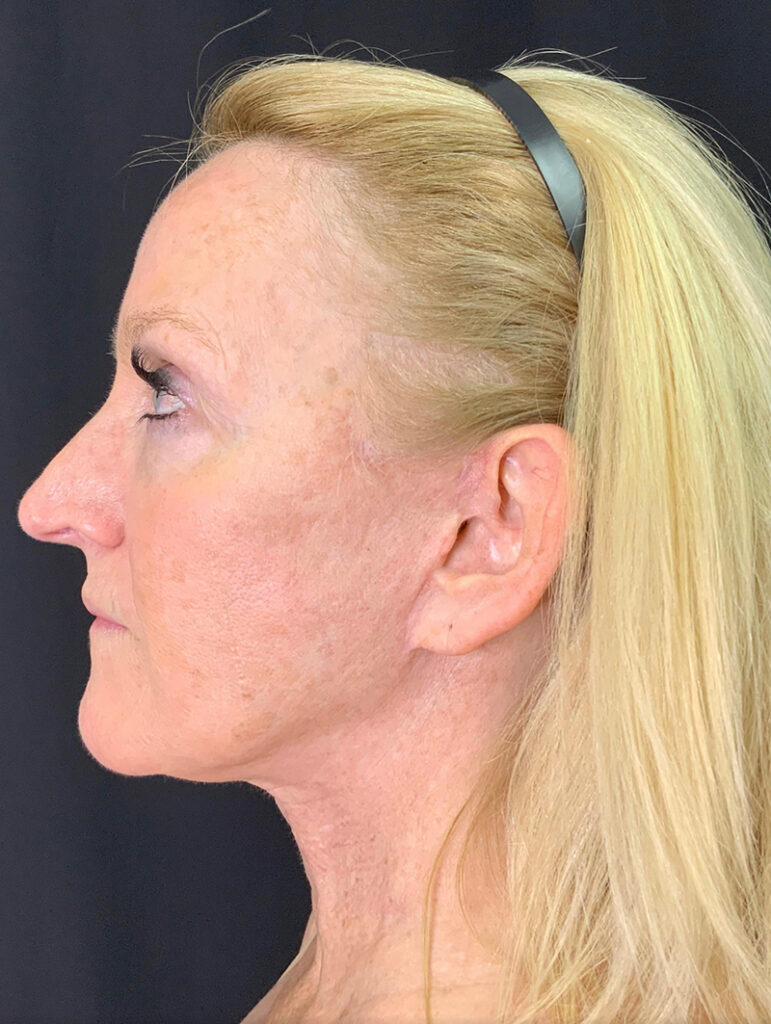 Profile view of a woman highlighting facial contours post-surgery at Lentz Plastic Surgery.
