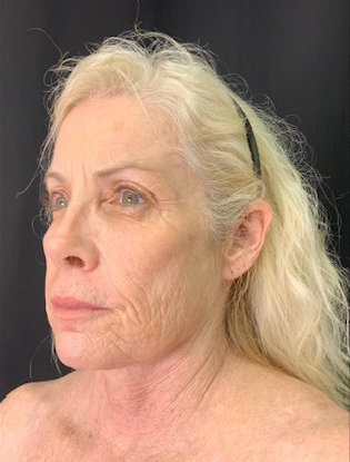Patient consultation highlighting natural beauty and aging concerns at Lentz Plastic Surgery.
