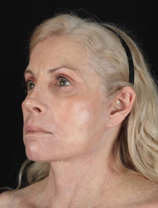 Profile view of a mature woman, highlighting natural beauty and skin rejuvenation.