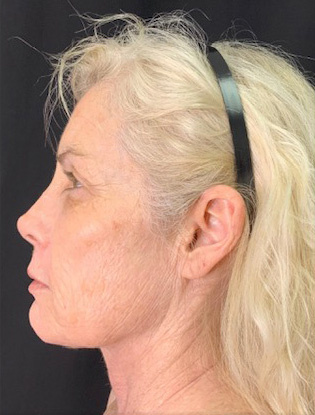 Profile view of a woman highlighting facial contours and skin texture.