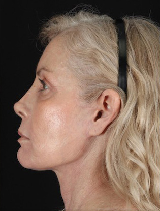 Profile view of a woman highlighting facial contours and skin texture. Lentz Plastic Surgery.