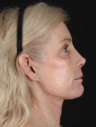 Profile view of a woman highlighting facial rejuvenation results.
