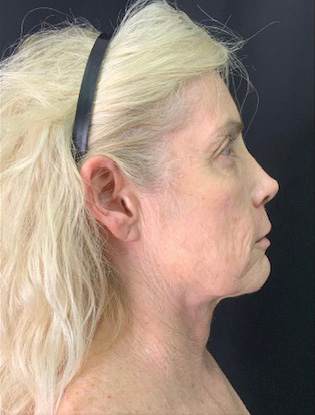 Profile view of a mature woman highlighting facial contours and skin texture.