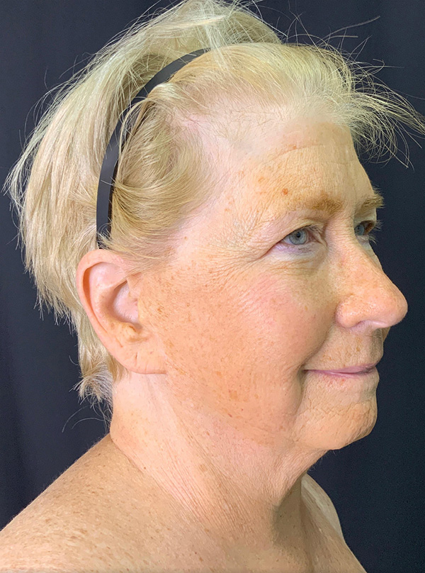 Profile view of a mature woman showcasing natural skin texture and subtle facial contours.