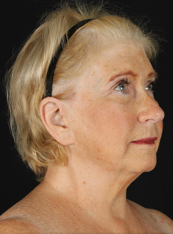 Profile view of mature woman showcasing natural beauty post-surgery.