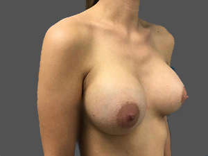Breast augmentation results highlighting natural contours and professional care.
