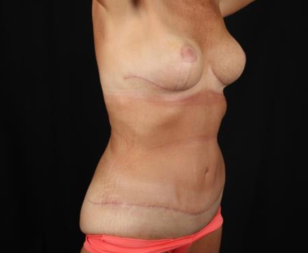Post-surgery body contouring results showcasing smooth silhouette and healing.