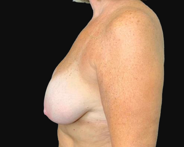 Breast augmentation side view showcasing natural results by Lentz Plastic Surgery.