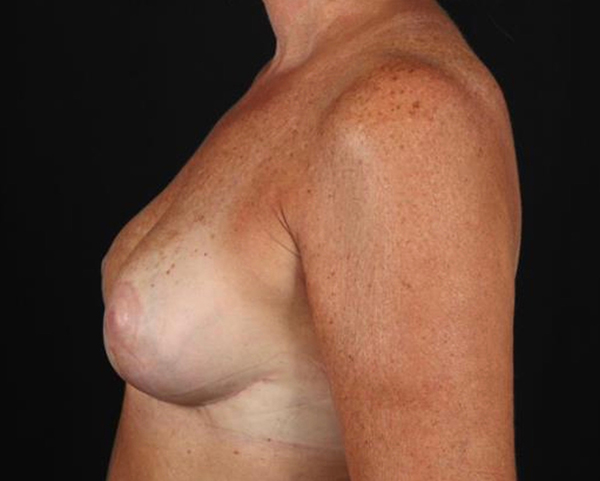 Breast augmentation result showcasing natural contours and skin tone.