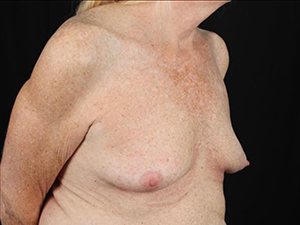 Before and after breast enhancement results at Lentz Plastic Surgery.