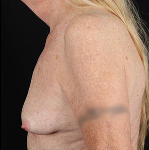 Profile view of a patient post-surgery, highlighting natural results at Lentz Plastic Surgery.