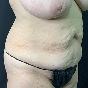 Realistic body model highlighting skin texture and contours for surgical consultation.