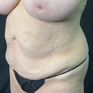 Realistic body model highlighting skin texture for Lentz Plastic Surgery.