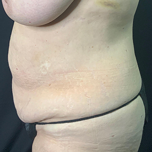 Before and after body contouring results at Lentz Plastic Surgery.