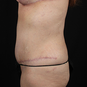 Post-surgery side view highlighting surgical results and recovery at Lentz Plastic Surgery.