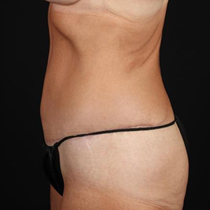 Side view of a woman's abdomen highlighting post-surgery results.