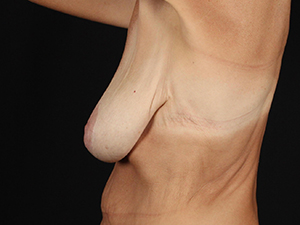 Breast reconstruction showcasing natural contour and professional results.