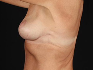 Before and after breast augmentation side view, showcasing natural results.