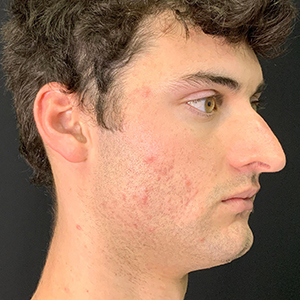 Male patient profile showcasing skin texture before treatment at Lentz Plastic Surgery.