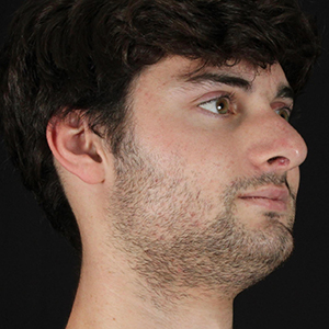 Male patient profile showcasing facial aesthetics at Lentz Plastic Surgery.