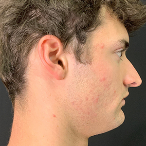 Profile view of a young man with acne, highlighting skin concerns for Lentz Plastic Surgery.