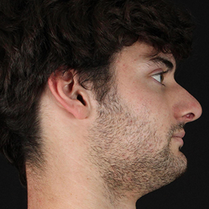 Profile view of a male patient highlighting facial contours for Lentz Plastic Surgery.